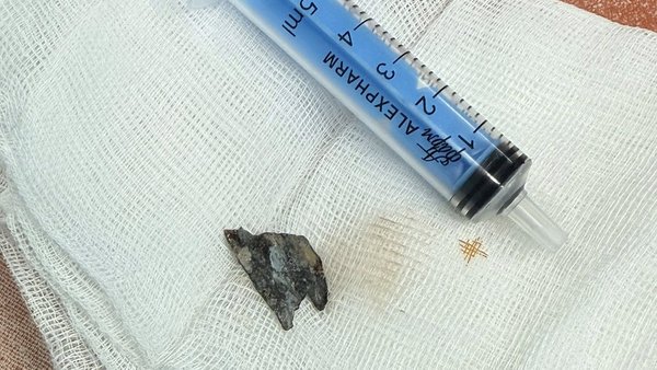 Київські лікарі вилучили металевий осколок з грудної порожнини бійця.