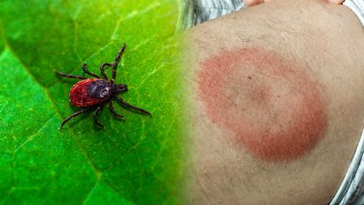 Київ: старт сезону кліщів, лікарі застерігають щодо хвороби Лайма.